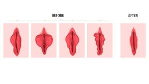 labioplasti ameliyatı nedir